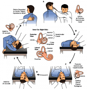 nghiệm pháp epley