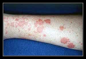 CRIOGLOBULIN – HUYẾT