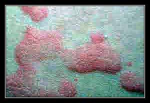 DẤU HIỆU BAN ĐỎ NÚT