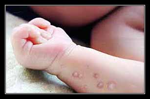 BỌNG NƯỚC TRÊN DA CỦA TRẺ EM