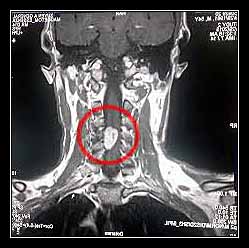 tủy bị chèn ép