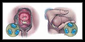 chảy ở niêu đạo