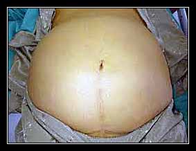 bệnh cổ trướng