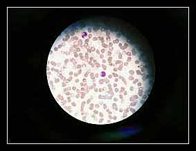 giảm bạch cầu trung tính