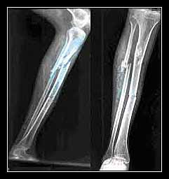 gãy xương tự phát