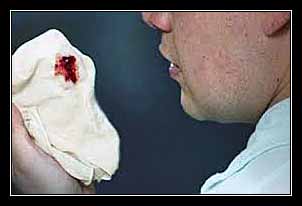 MẤT QUÁ NHIỀU HỒNG CẦU