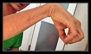 liệt dây thần kinh quay