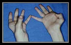 liệt dây thần kinh trụ