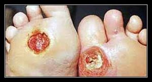 loét khoét gan bàn chân