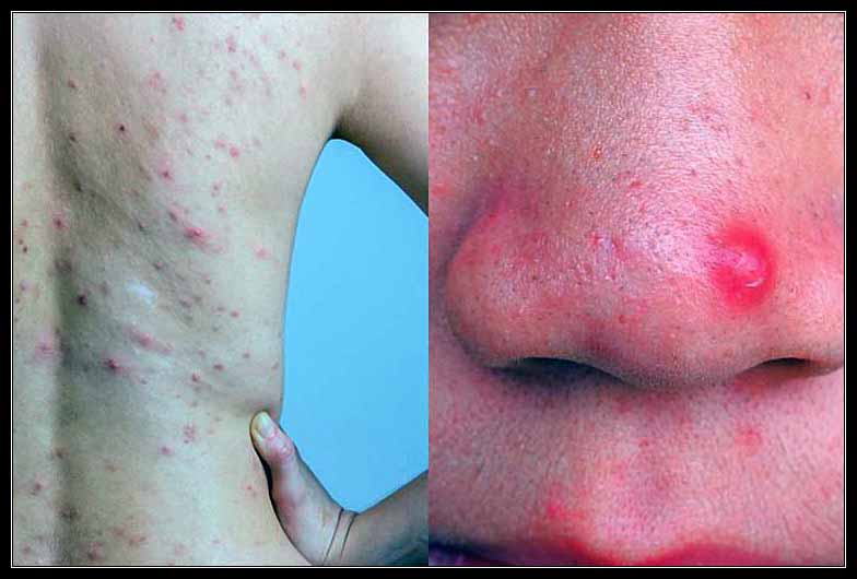 MỤN VÀ CÁCH ĐIỀU TRỊ