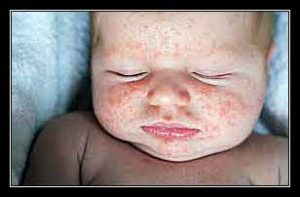 phát ban bóng nước ở trẻ