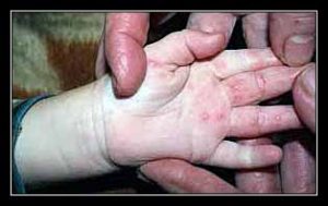 phát ban bóng nước