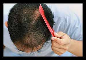 SÓI ĐẦU (Rụng tóc)