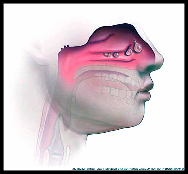 NGUYÊN NHÂN GÂY SỔ MŨI