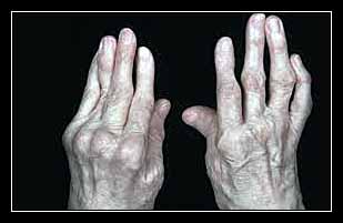 THẤP ĐA KHỚP TÁI NHIỄM