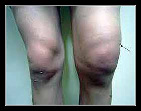 TRÀN DỊCH KHỚP GỐI