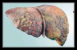 TĂNG HUYẾT ÁP TĨNH MẠCH CỬA