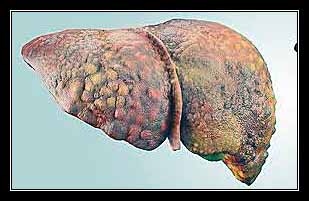 TĂNG HUYẾT ÁP TĨNH MẠCH CỬA