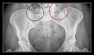 viêm khớp cùng chậu