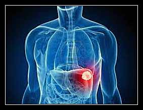 vôi hóa trong ổ bụng