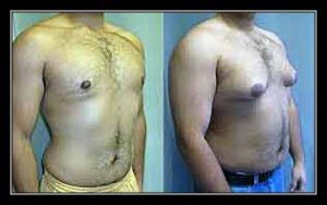 vú to ở đàn ông