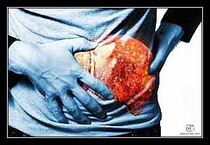 CHẢY MÁU Ở NGƯỜI XƠ GAN HOẶC NGƯỜI BỊ BỆNH GAN