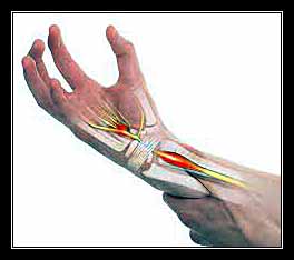 ỐNG KHỐI XƯƠNG CỔ TAY (Hội chứng)