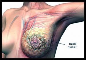 CÁC LOẠI UNG THƯ PHỔ BIẾN NHẤT