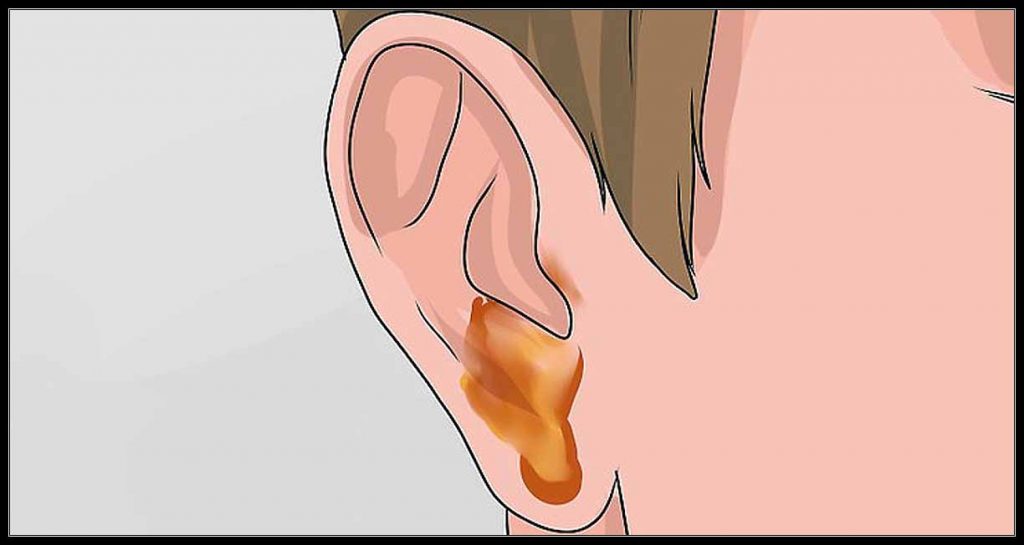 VIÊM TAI GIỮA CẤP