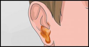 VIÊM TAI GIỮA CẤP