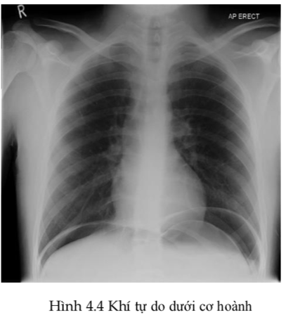 khí tự do dưới cơ hoành