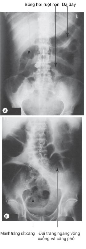x quang tắc ruột