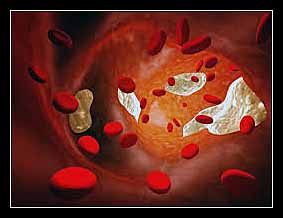 điều kiện mắc bệnh tim