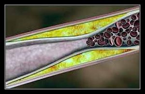 BIẾN CHỨNG BỆNH TĂNG HUYẾT ÁP