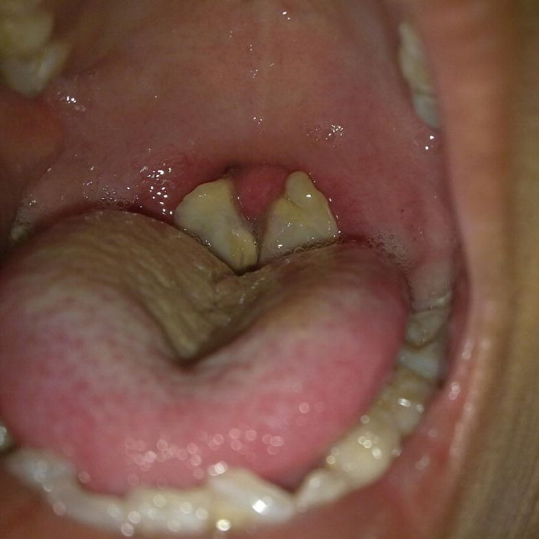 Bệnh bạch hầu là gì?