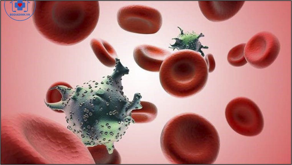 Bệnh bạch cầu (ung thư máu)