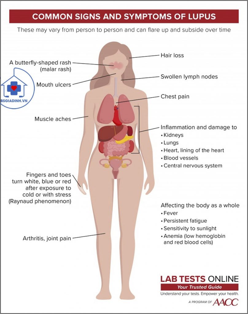 Lupus ban đỏ Kháng thể kháng nhân (ANA)