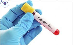xét nghiệm Bilirubin