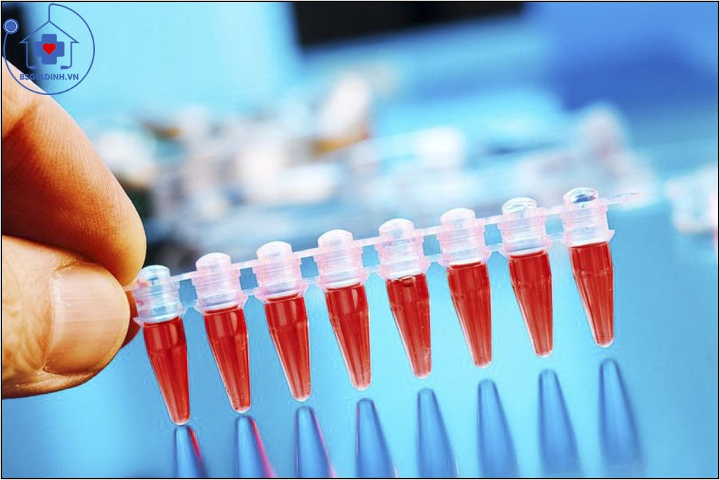 xét nghiệm d-dimer