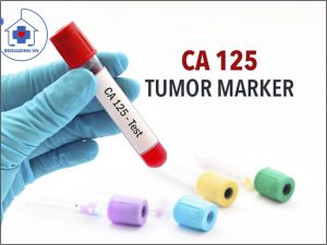 xét nghiệm CA 125