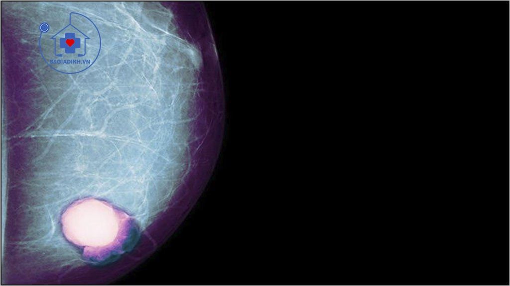 xét nghiệm CA 15-3