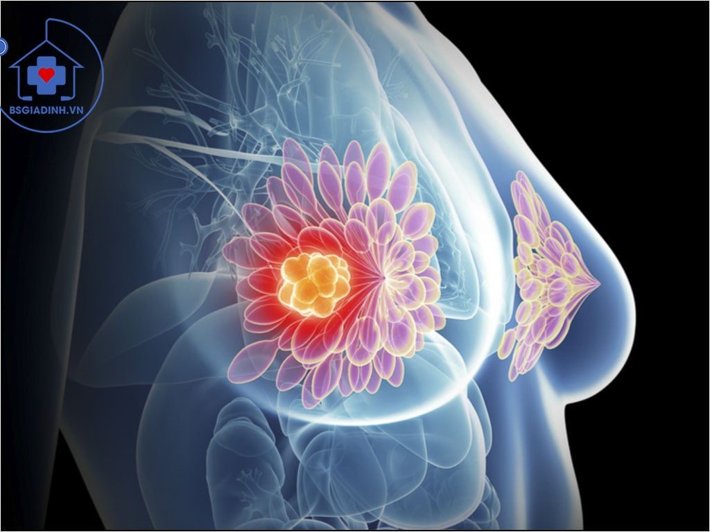 xét nghiệm CA 15-3