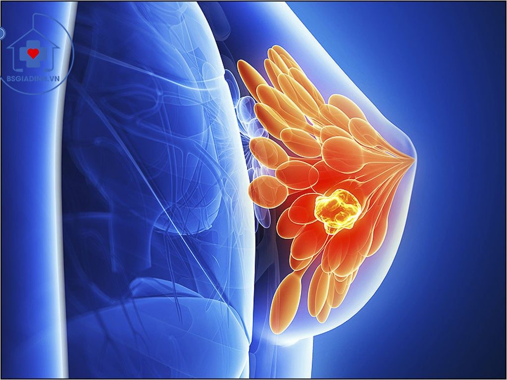 xét nghiệm CA 15-3