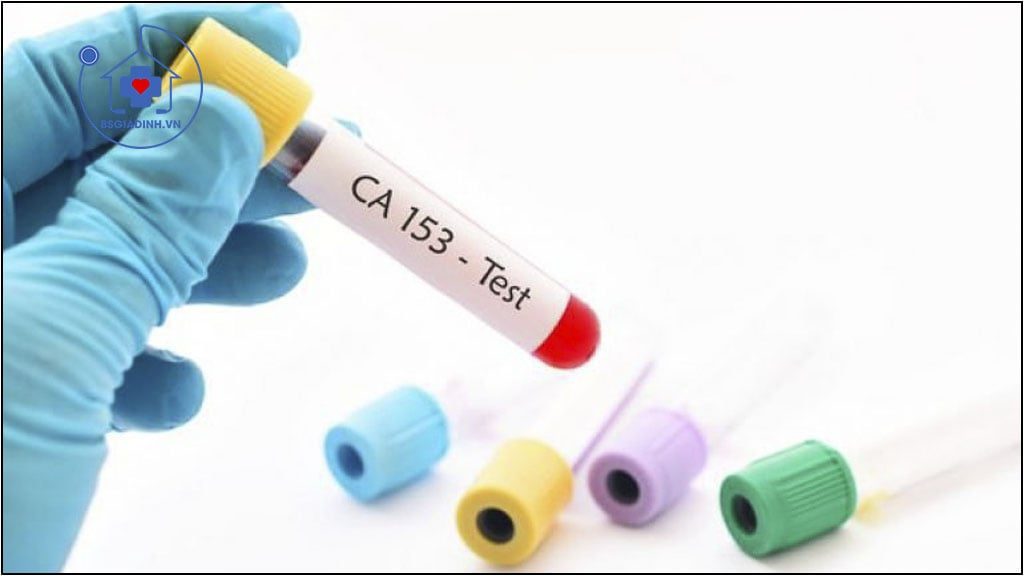 CA 15-3  là gì? Các nguyên nhân tăng nồng độ xét nghiệm CA 15-3 ?