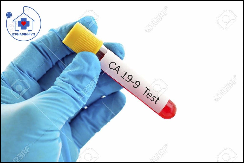 CA 19-9 là gì? Xét nghiệm CA 19-9 tăng giảm khi nào?