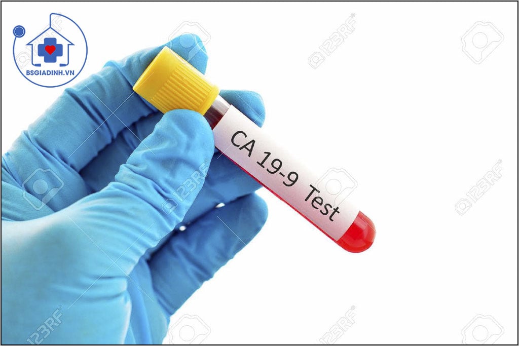 xét nghiệm CA 19-9