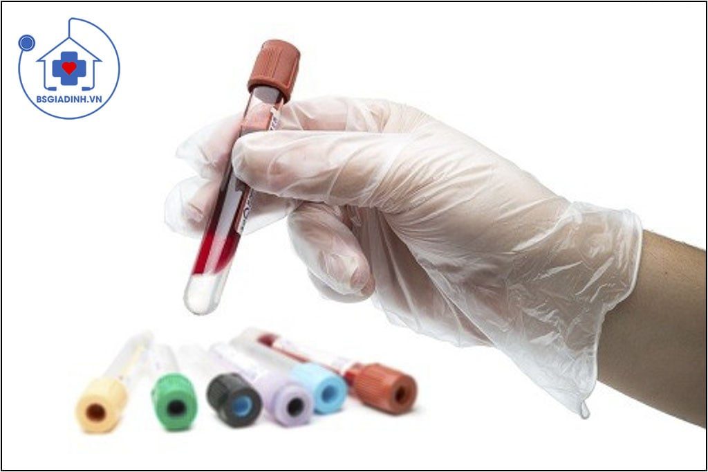 xét nghiệm CA 19-9