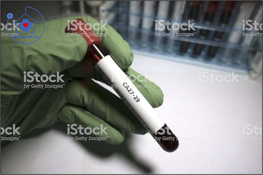 xét nghiệm CA 27-29