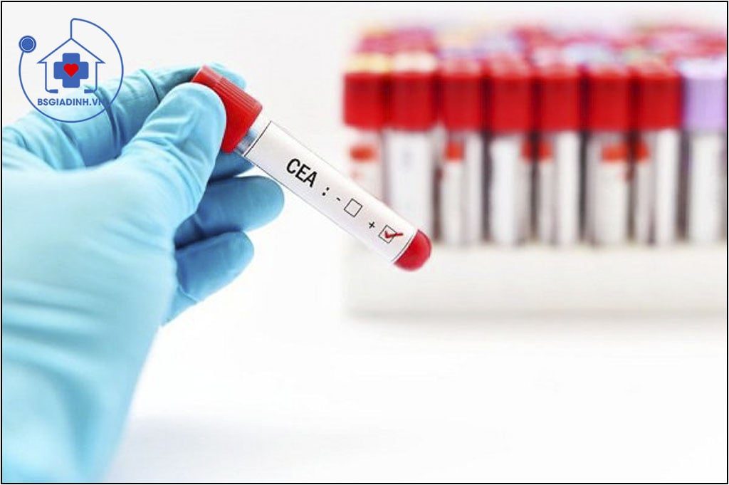 xét nghiệm CEA