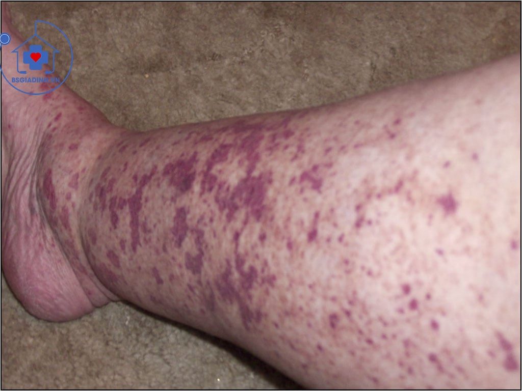 xét nghiệm Cryoglobulin